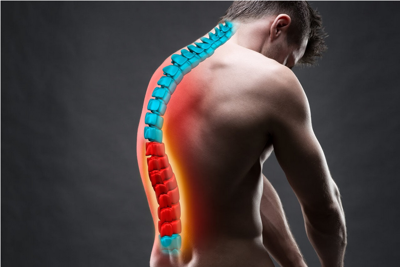 a person suffering from kyphosis