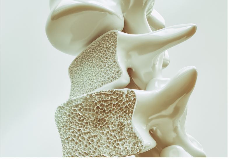 5 Natural Remedies for Osteoporosis That May Help
